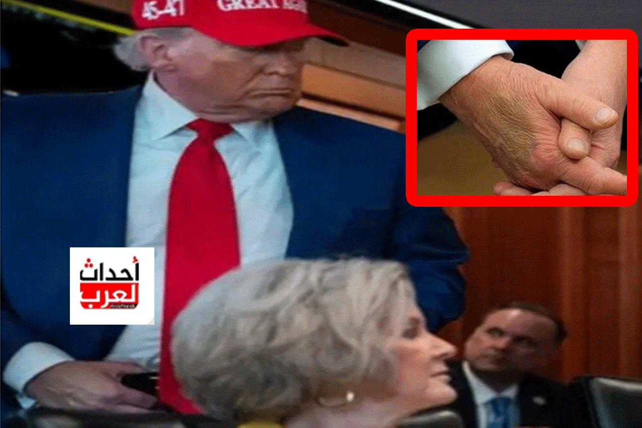 سر الكدمة التي ظهرت في يد ترامب.. ومدى خطورتها الصحية عليه